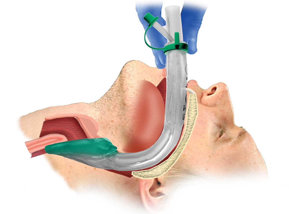 Simple airway maneuvers