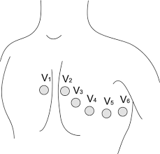 12-lead ECG