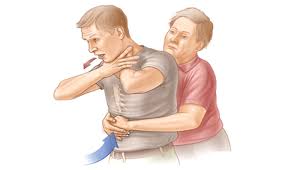 Heimlich maneuver